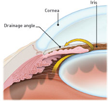 If the drainage angle is blocked, excess fluid cannot flow out of the eye, causing the fluid pressure to increase.