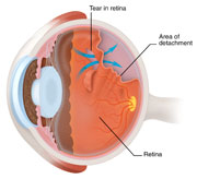 Vitreous detachment