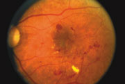 A retina showing signs of diabetic retinopathy diabet-retina-180px