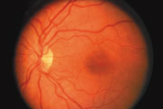 A normal retina normal-retina-180px